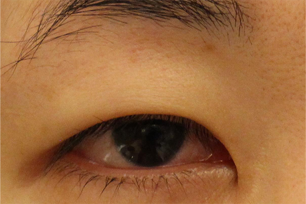 眼瞼下垂手術後の修正手術 オキュロフェイシャルクリニック東京 眼瞼下垂手術後の修正手術 オキュロフェイシャルクリニック東京