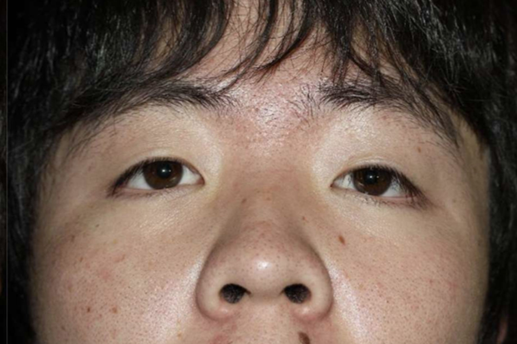 術後