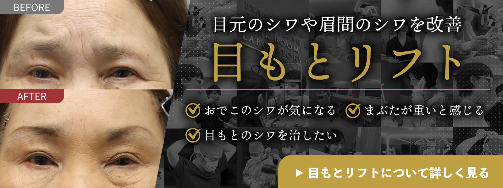 目もとリフト