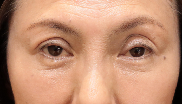 眼瞼下垂修正手術 術後