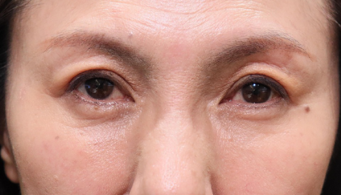 眼瞼下垂修正手術 術後