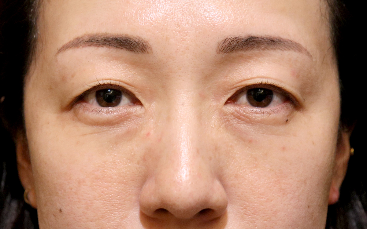 眼瞼下垂手術の症例 術前