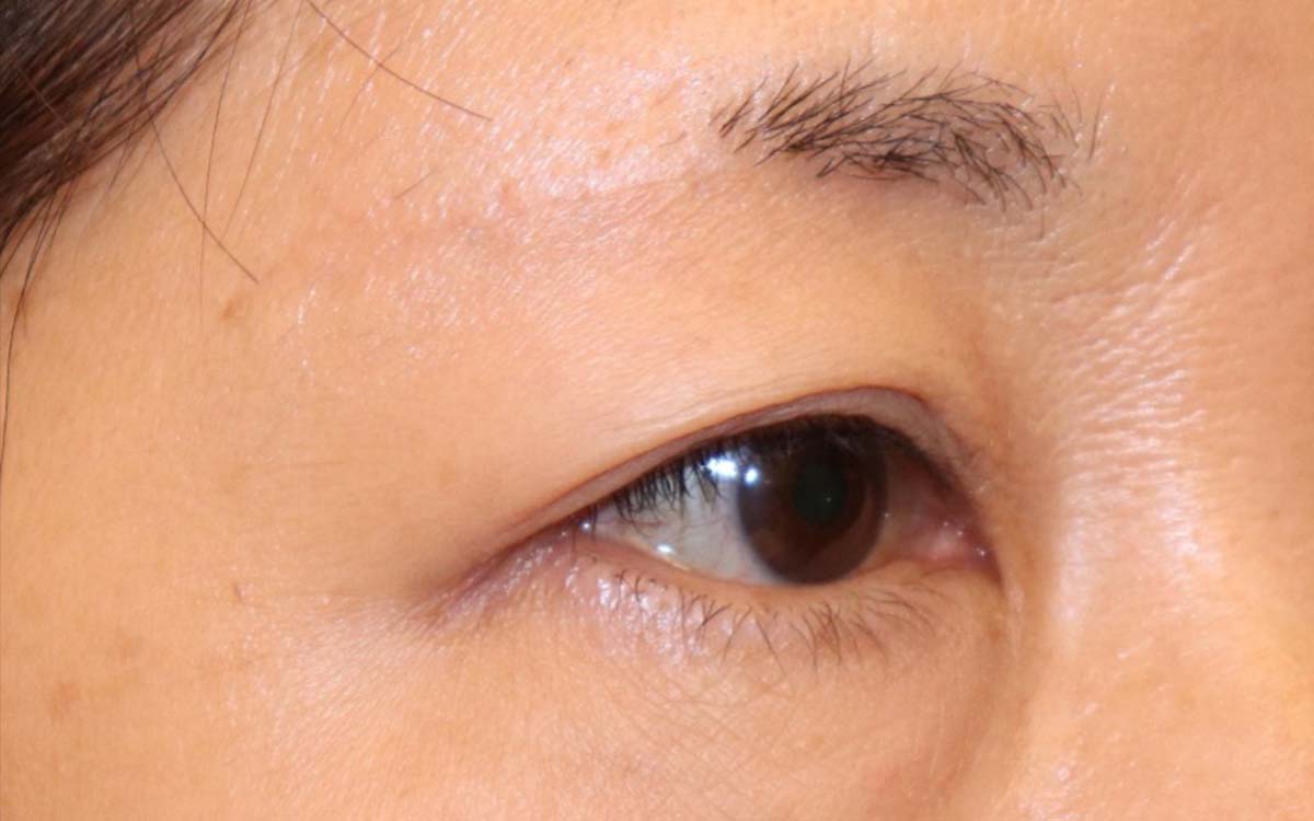 眼瞼下垂手術の症例 術後