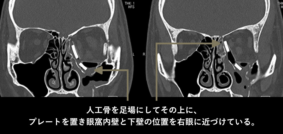 術後